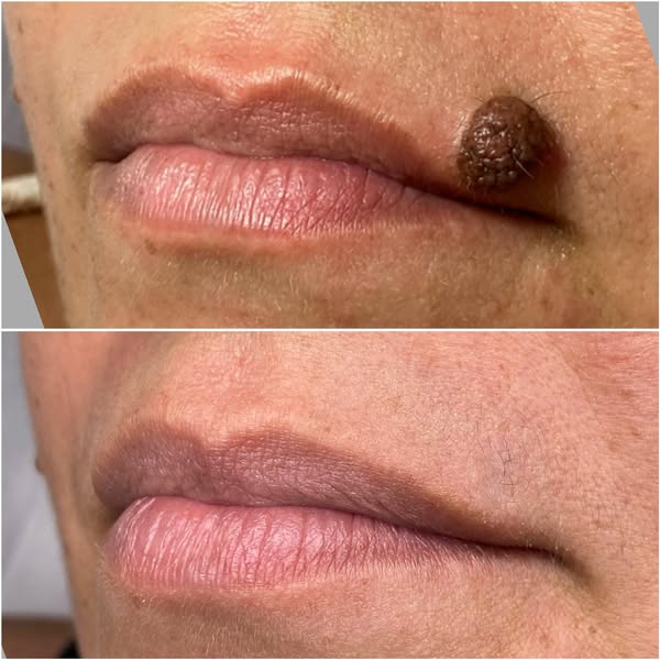 Antes e depois da remoção de verruga próxima ao lábio com Jato de Plasma